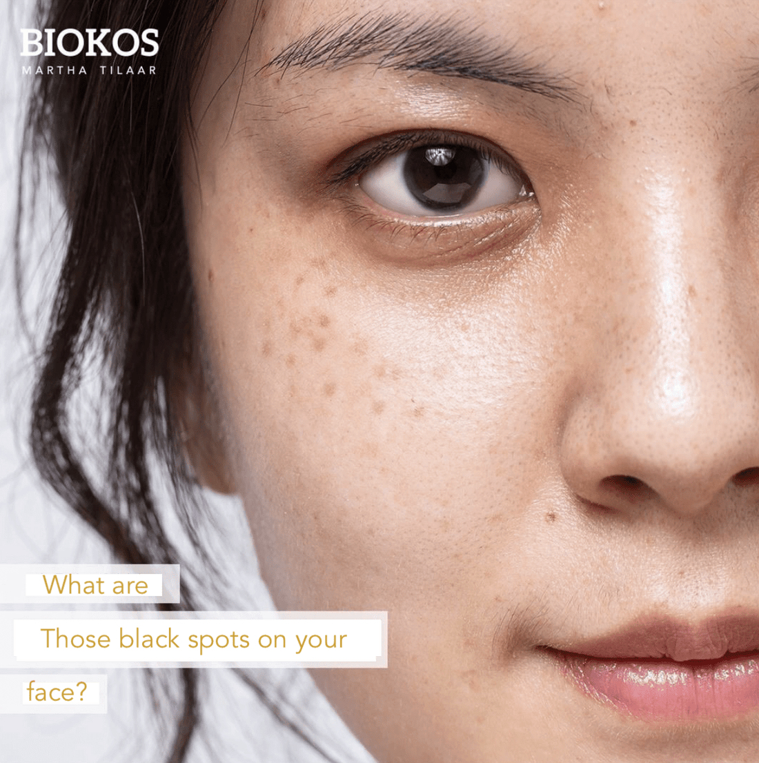 Black Spots on the face - Biokos Australia