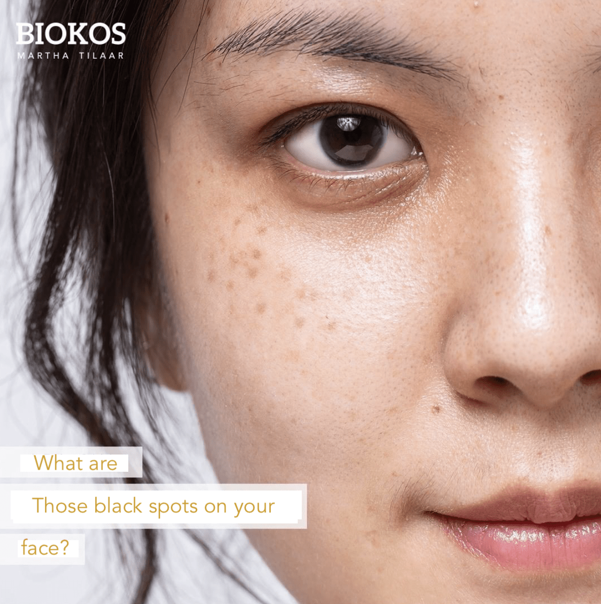 Black Spots on the face - Biokos Australia